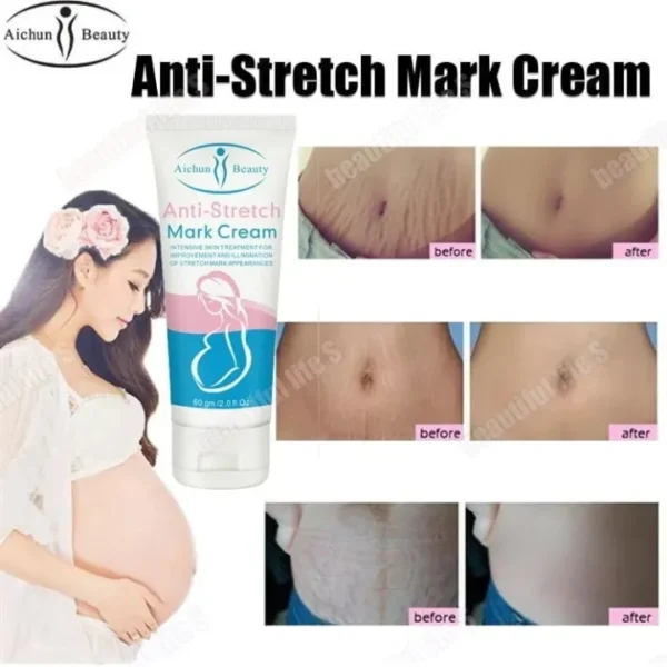 Anti Stretch Mark Cream