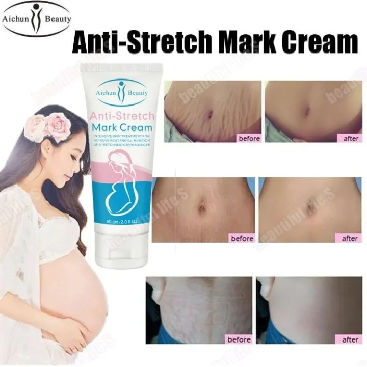 Anti Stretch Mark Cream