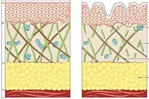 Anti Stretch Mark Cream