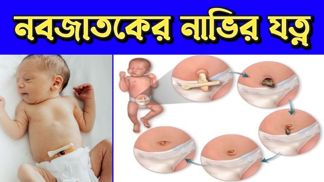 নবজাতক শিশুর নাভি যত্ন: করণীয়, সতর্কতা ও সমাধান