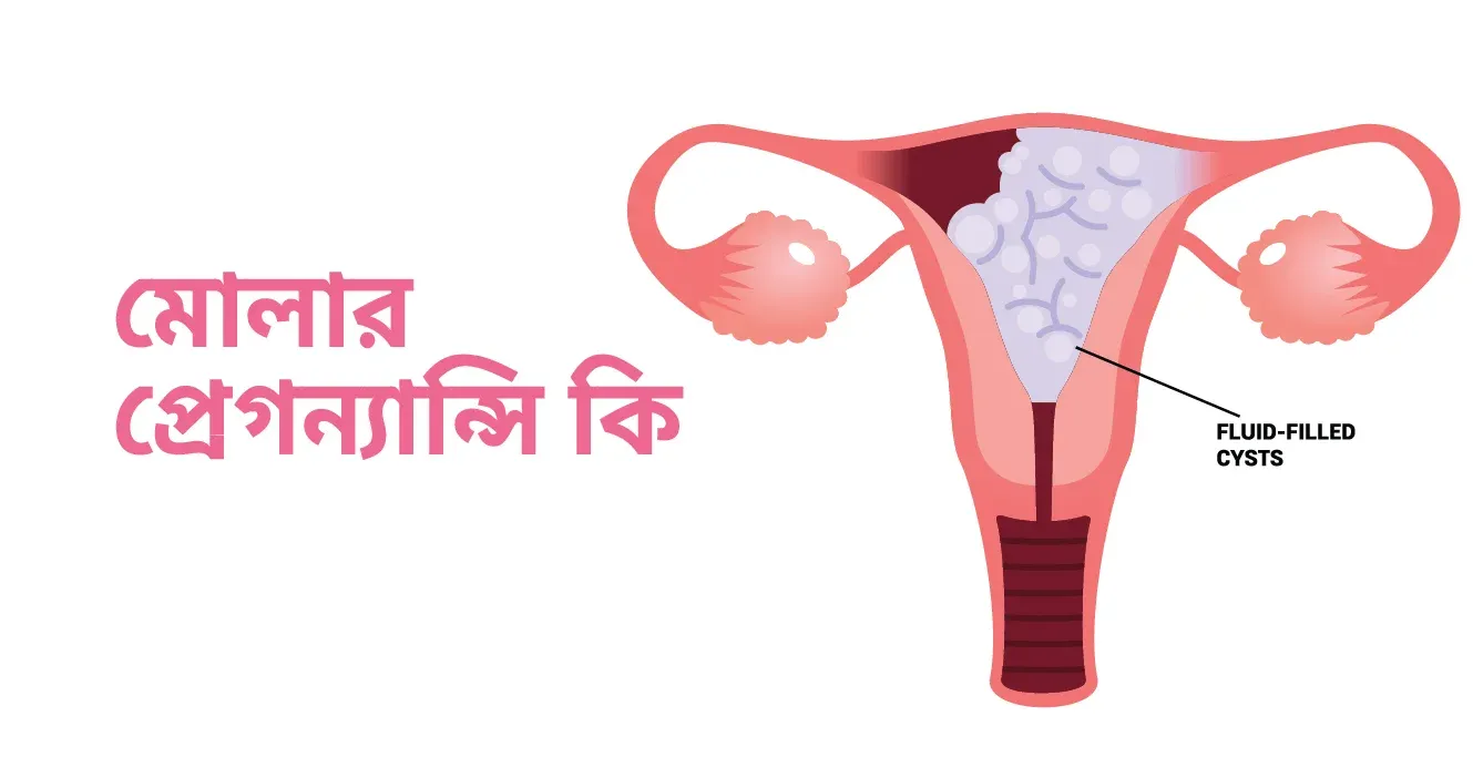 মোলার প্রেগনেন্সি কি?- কারণ, লক্ষণ, চিকিৎসা ও প্রতিরোধ