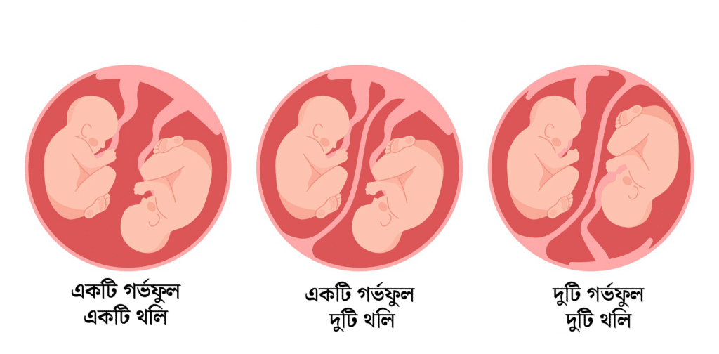 গর্ভে যমজ শিশু