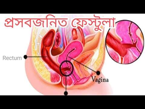 প্রসবজনিত ফিস্টুলা