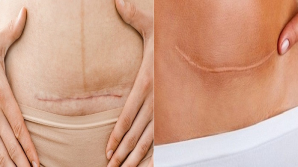 সিজারের পর দ্রুত সুস্থ হওয়ার উপায়: মায়েদের জন্য সম্পূর্ণ গাইড